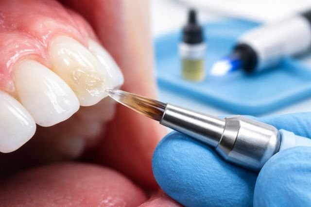can you use resin on resin for teeth